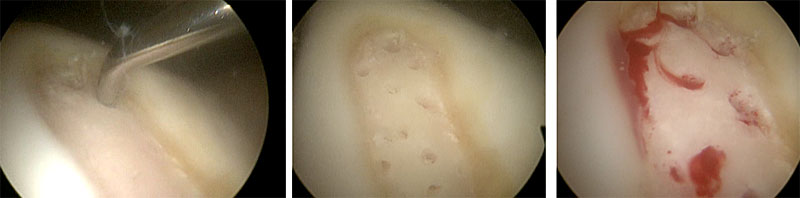   image showing Micro fracture of the defect good bleeding seen into the defect which will form a fibrin clot then go onto form fibrocartilage, treated by Mr Aslam Mohammed.